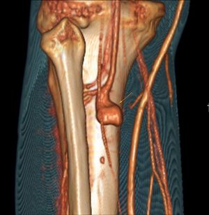 Mycotic Aneurysms
