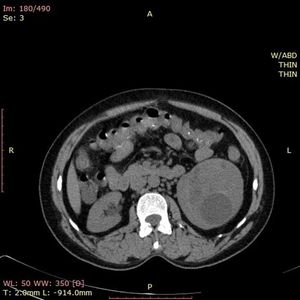 Renal Hydatid Disease
