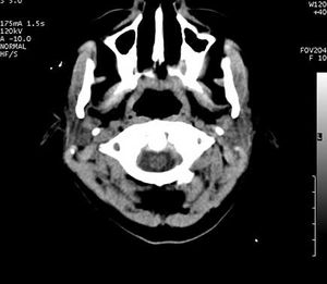 Brain Abscess 