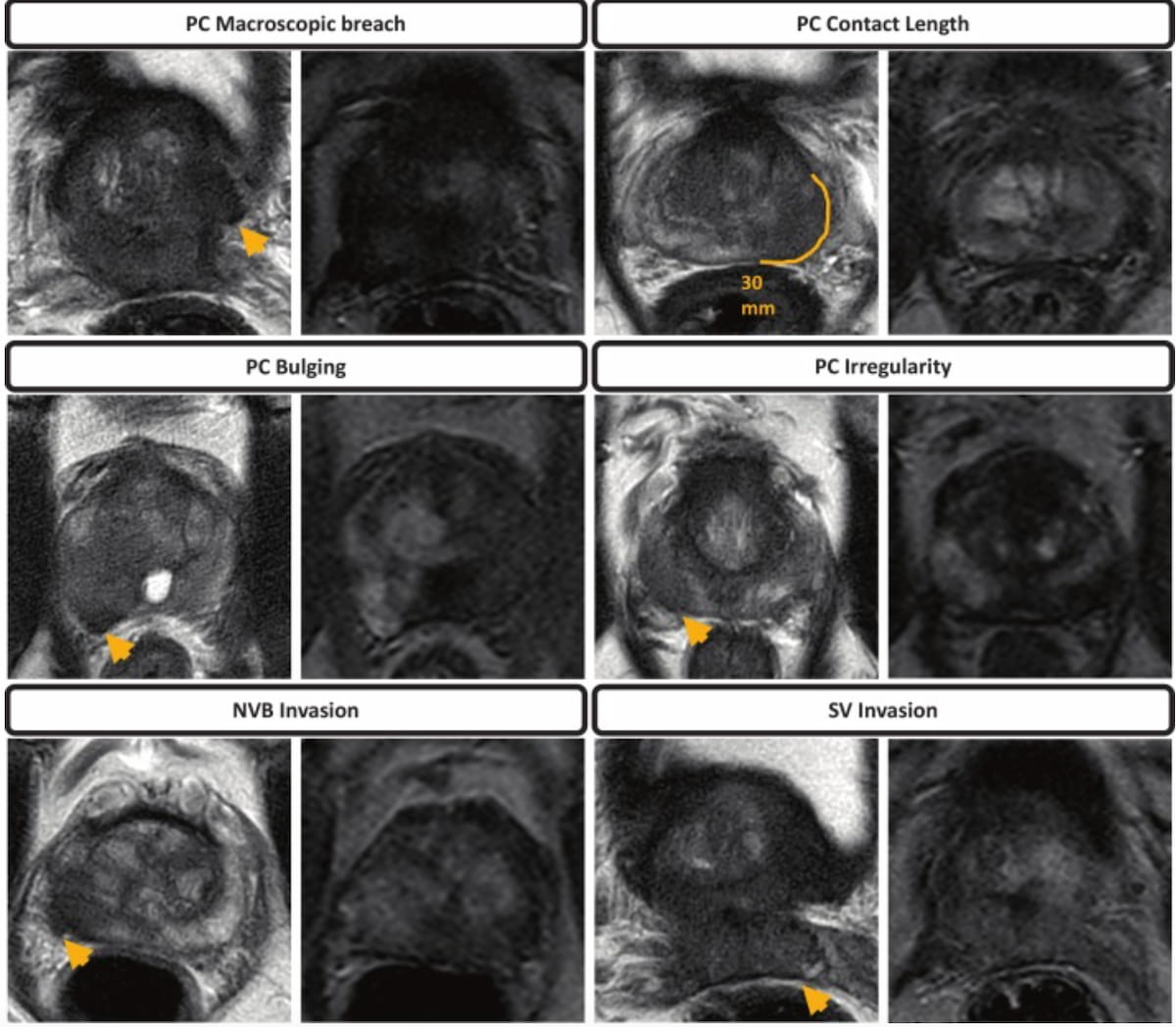 Does bpMRI Offer Similar Value to mpMRI in Detection of Extraprostatic Extension in Patients with PCa?