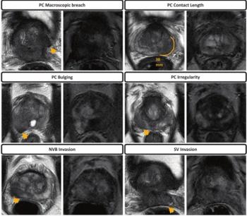 Does bpMRI Offer Similar Value to mpMRI in Detection of Extraprostatic Extension in Patients with PCa?