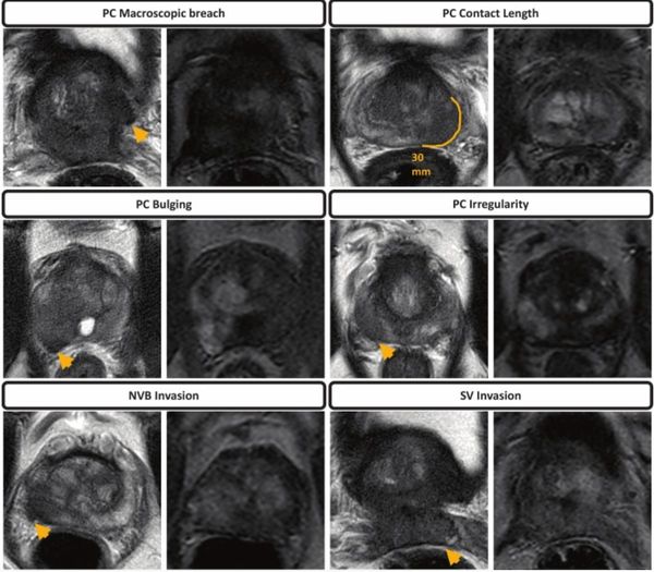 Does bpMRI Offer Similar Value to mpMRI in Detection of Extraprostatic Extension in Patients with PCa?