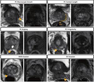 Does bpMRI Offer Similar Value to mpMRI in Detection of Extraprostatic Extension in Patients with PCa?