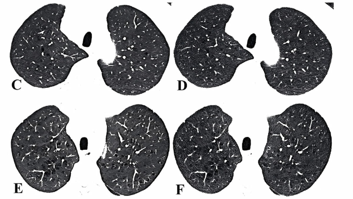 Photon-Counting CT Facilitates 87 Percent Reduction in Radiation Dosing for Emphysema Assessment