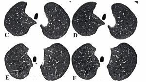 Photon-Counting CT Facilitates 87 Percent Reduction in Radiation Dosing for Emphysema Assessment