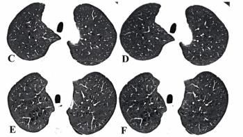 Photon-Counting CT Facilitates 87 Percent Reduction in Radiation Dosing for Emphysema Assessment