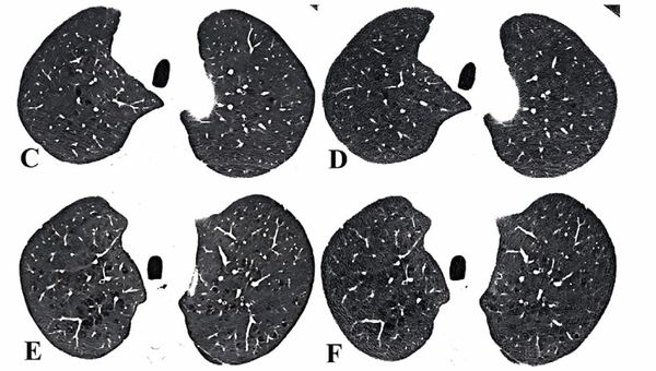 Photon-Counting CT Facilitates 87 Percent Reduction in Radiation Dosing for Emphysema Assessment