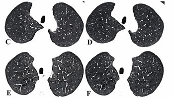 Photon-Counting CT Facilitates 87 Percent Reduction in Radiation Dosing for Emphysema Assessment