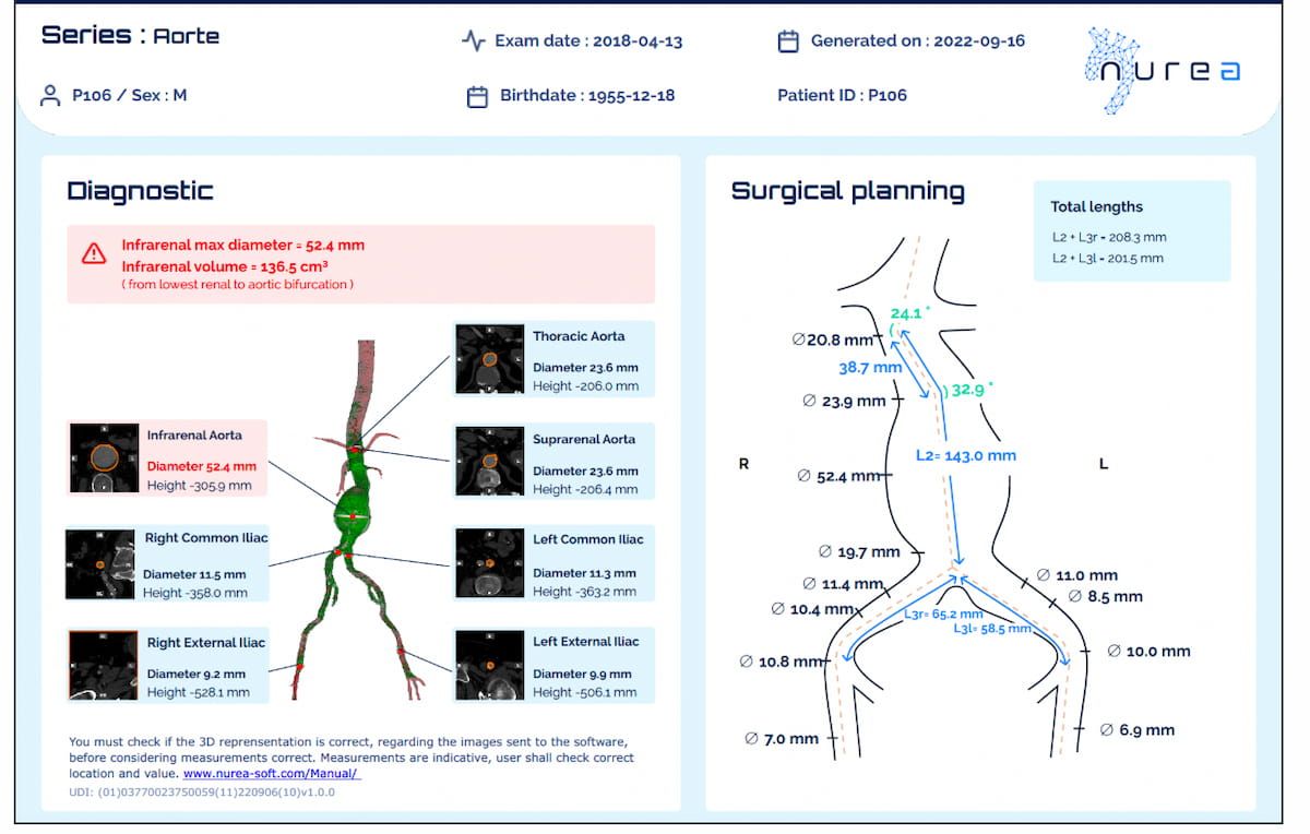 FDA Clears CT-Based AI Software for Assessment of Aortic Aneurysms