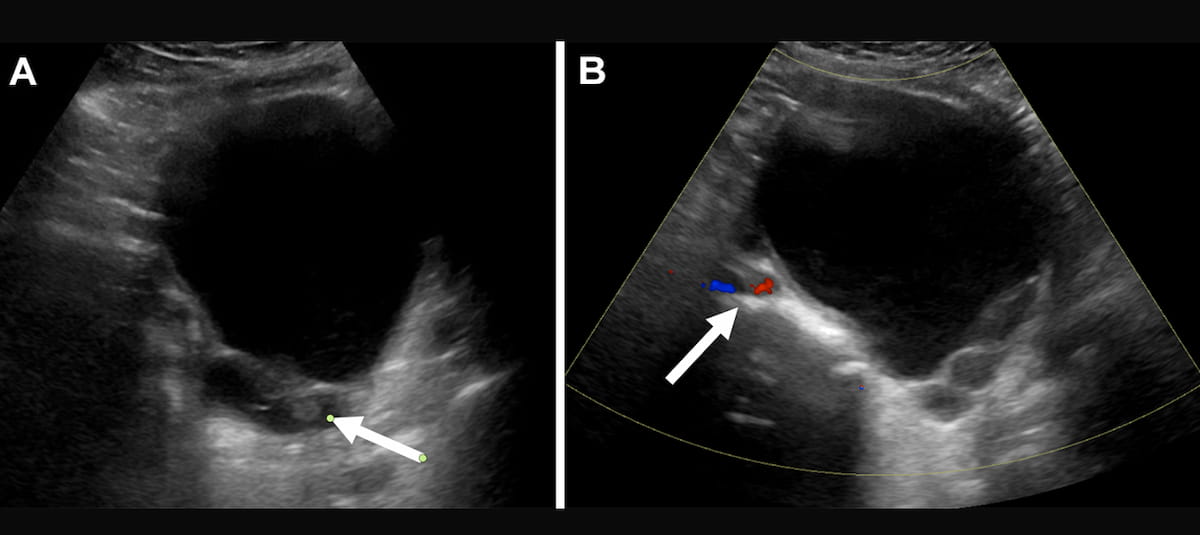 Study: Over 60 Percent of O-RADS 4 and 5 Scored Lesions on Ultrasound Are Benign