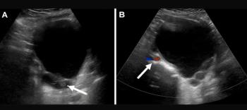 Study: Over 60 Percent of O-RADS 4 and 5 Scored Lesions on Ultrasound Are Benign