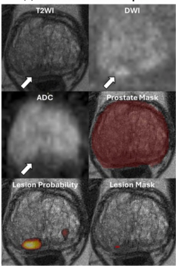 New bpMRI Study Suggests AI Offers Comparable Results to Radiologists for PCa Detection