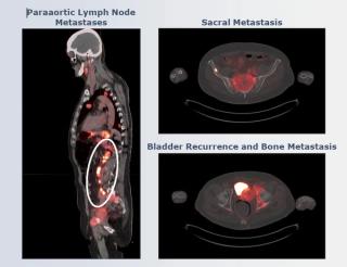 Emerging Mini-Protein Radioconjugate Gets FDA Fast Track Designation for Advanced and Metastatic Urothelial Cancer