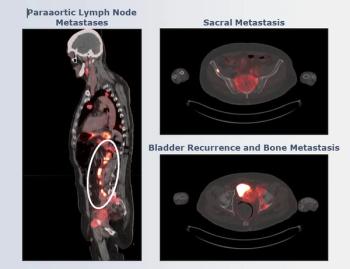 Emerging Mini-Protein Radioconjugate Gets FDA Fast Track Designation for Advanced and Metastatic Urothelial Cancer