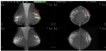How Does Access to Previous Mammography Exams Impact Current Mammography Interpretation by Radiologists?