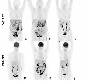 Can FAPI PET Enhance Pre-Op Evaluation of Peritoneal Carcinomatosis?
