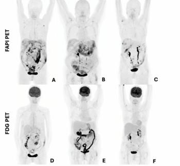 Can FAPI PET Enhance Pre-Op Evaluation of Peritoneal Carcinomatosis?