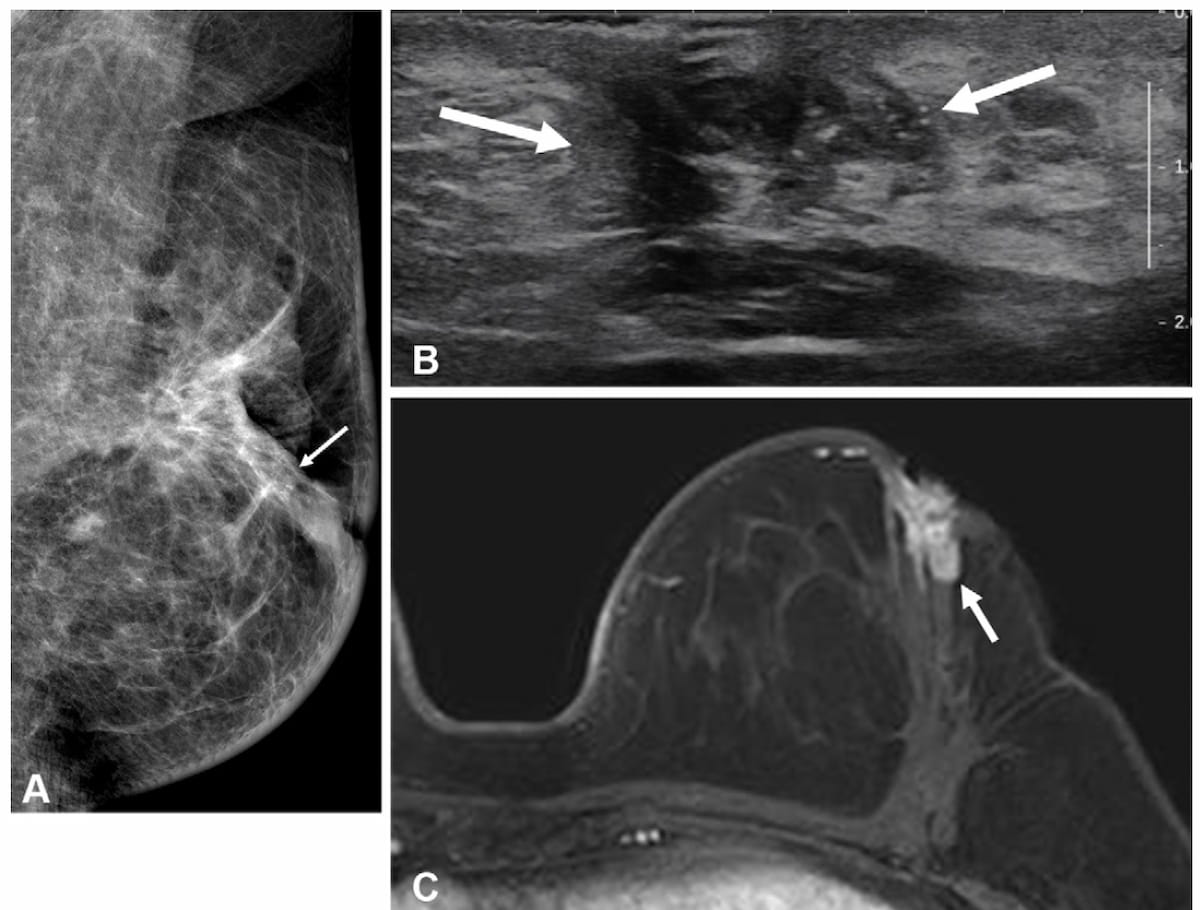 New Research Assesses the Impact of Pre-Op MRI on Breast Cancer Recurrence