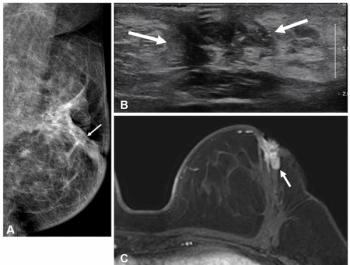 New Research Assesses the Impact of Pre-Op MRI on Breast Cancer Recurrence