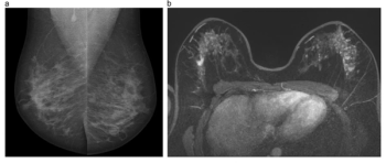 European Society of Breast Imaging Issues Updated Breast Cancer Screening Recommendations