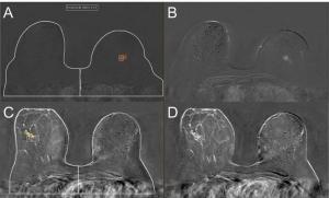 Study Reveals Mixed Results with Deep Learning Model for Breast MRI