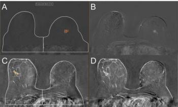 Study Reveals Mixed Results with Deep Learning Model for Breast MRI