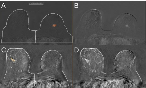 Study Reveals Mixed Results with Deep Learning Model for Breast MRI
