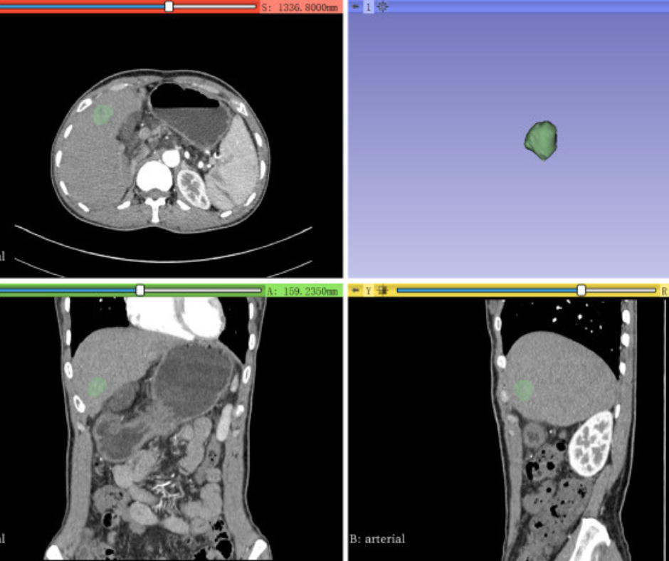 CT Radiomics Nomogram Shows Promise in Predicting Early Recurrence of Hepatocellular Carcinoma After Liver Transplant