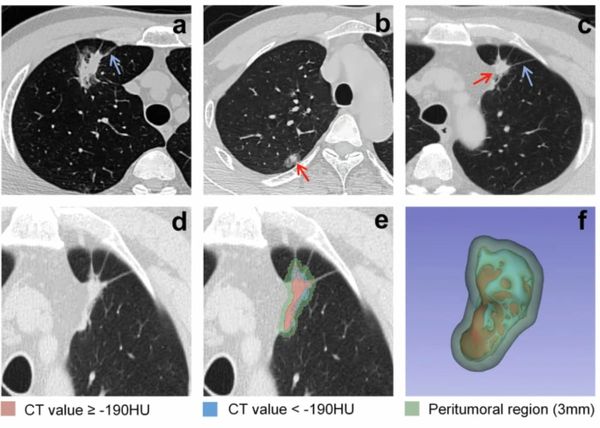 Can AI-Enabled Intratumoral CT Threshold Segmentation Help Predict Visceral Pleural Invasion in Lung Cancer Patients?