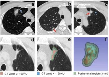 Can AI-Enabled Intratumoral CT Threshold Segmentation Help Predict Visceral Pleural Invasion in Lung Cancer Patients?