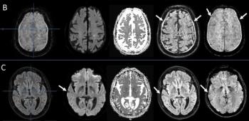 Stroke MRI Study Assesses Impact of Motion Artifacts Upon AI and Radiologist Lesion Detection