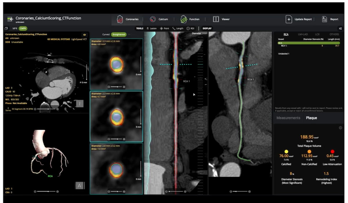 FDA Clears Plaque Assessment Software for Coronary CT Angiography