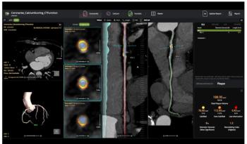 FDA Clears Plaque Assessment Software for Coronary CT Angiography