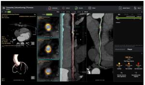 FDA Clears Plaque Assessment Software for Coronary CT Angiography