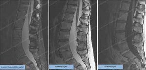 Ankylosing Spondylitis