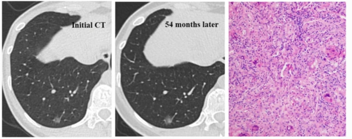 Current Insights On Differentiating Pulmonary Subsolid Nodules With Non ...