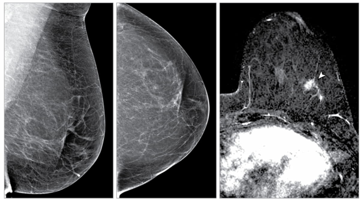 FDA Clears Updated Breast Acoustic CT Scanner with Improved