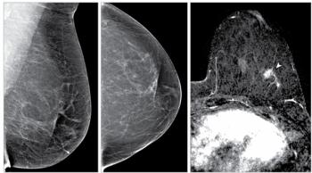 Mammography Study Suggests Deep Learning Model Offers More Accurate Risk Stratification than Breast Density