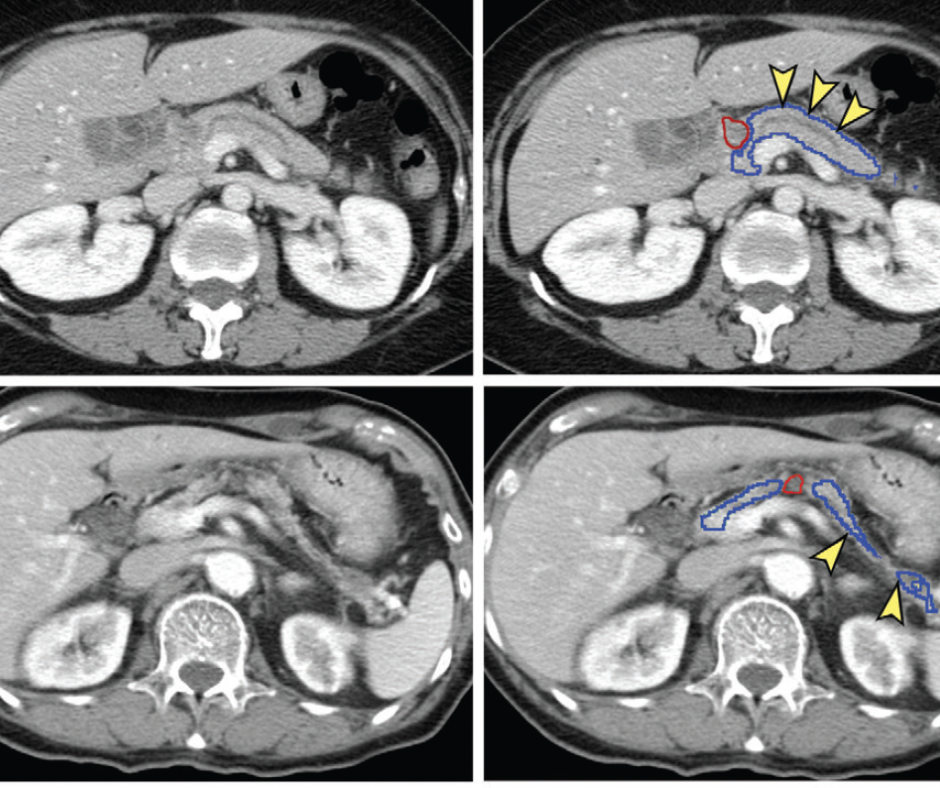 Can new deep learning tools enhance CT detection of pancreatic cancer?