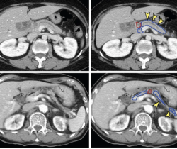 Could a New Deep Learning Tool Enhance CT Detection of Pancreatic Cancer?