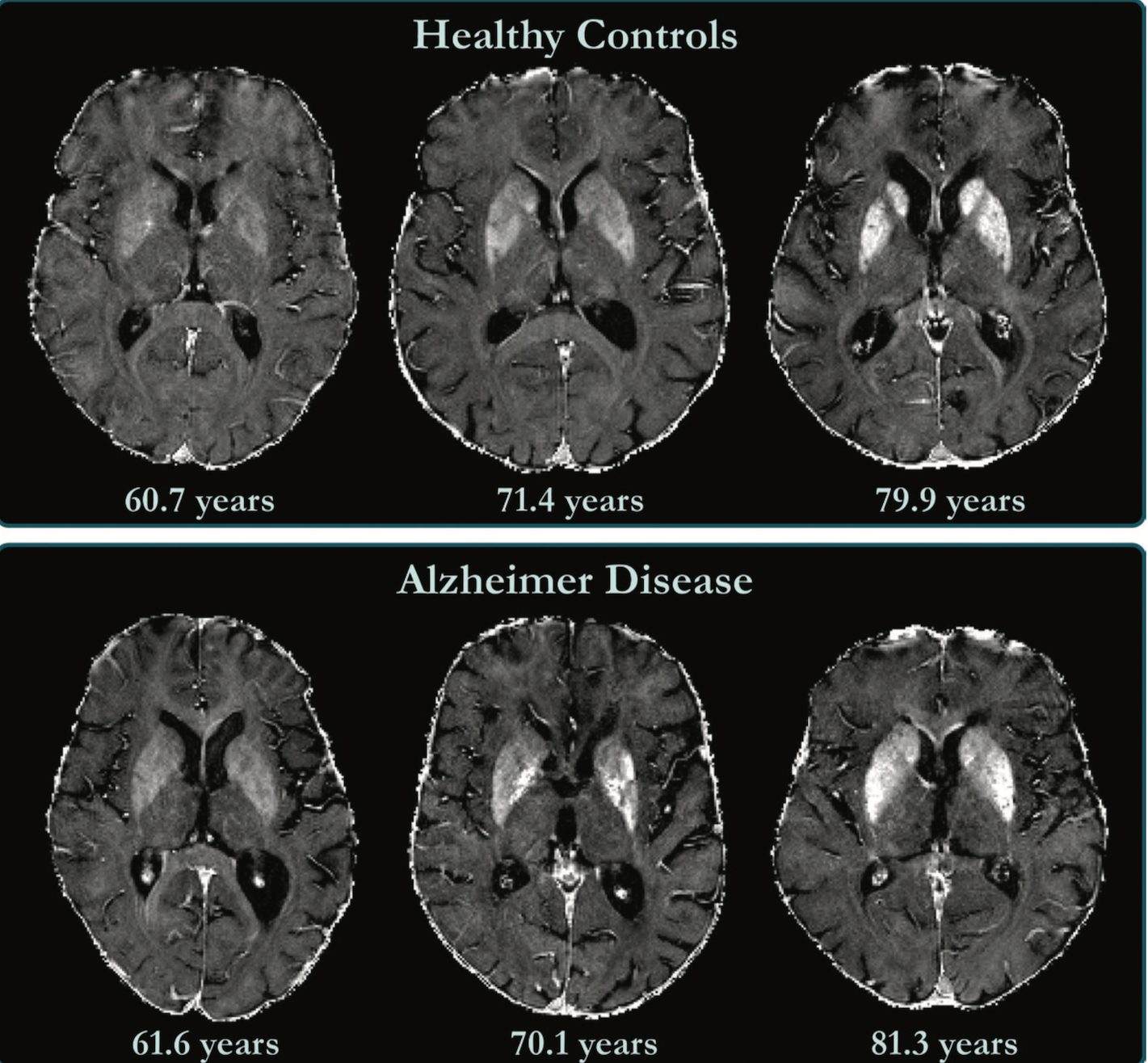 MRI Shows Link Between Higher Brain Iron Levels and Cognitive Decline ...