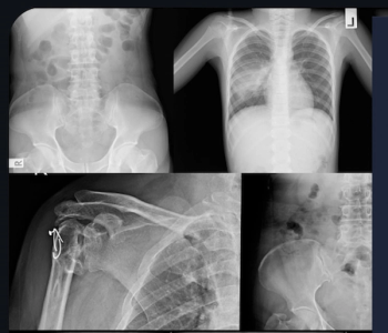 AI Software for X-Rays Gets FDA De Novo Classification for Bone Mineral Density Screening