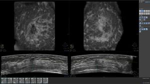 Using Automated Breast Ultrasound to Reduce or Eliminate Interval Cancers