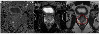 MRI-Based Deep Learning Model Bolsters Prediction of PI-RADS 3 and 4 Lesions