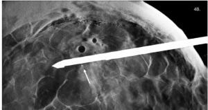 Mammography Study Shows Advantages of DBT Guidance for Breast Biopsies
