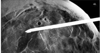 Mammography Study Shows Advantages of DBT Guidance for Breast Biopsies
