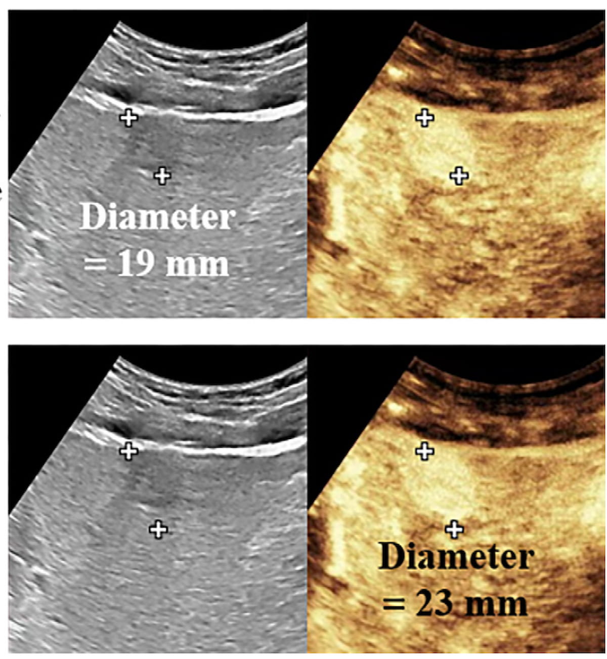 Tumor Margin Marker on Contrast-Enhanced Ultrasound May Predict Worse Outcomes in Patients with HCC