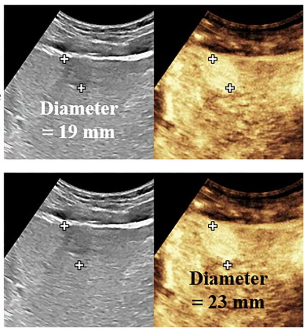 Tumor Margin Marker on Contrast-Enhanced Ultrasound May Predict Worse Outcomes in Patients with HCC