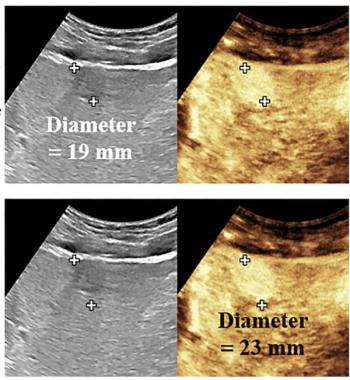 Tumor Margin Marker on Contrast-Enhanced Ultrasound May Predict Worse Outcomes in Patients with HCC