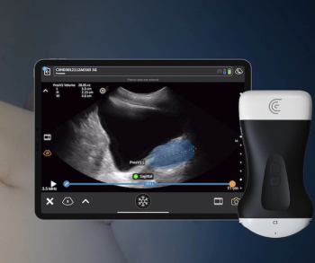 FDA Clears AI-Powered Prostate Volume Measurement for Handheld Ultrasound